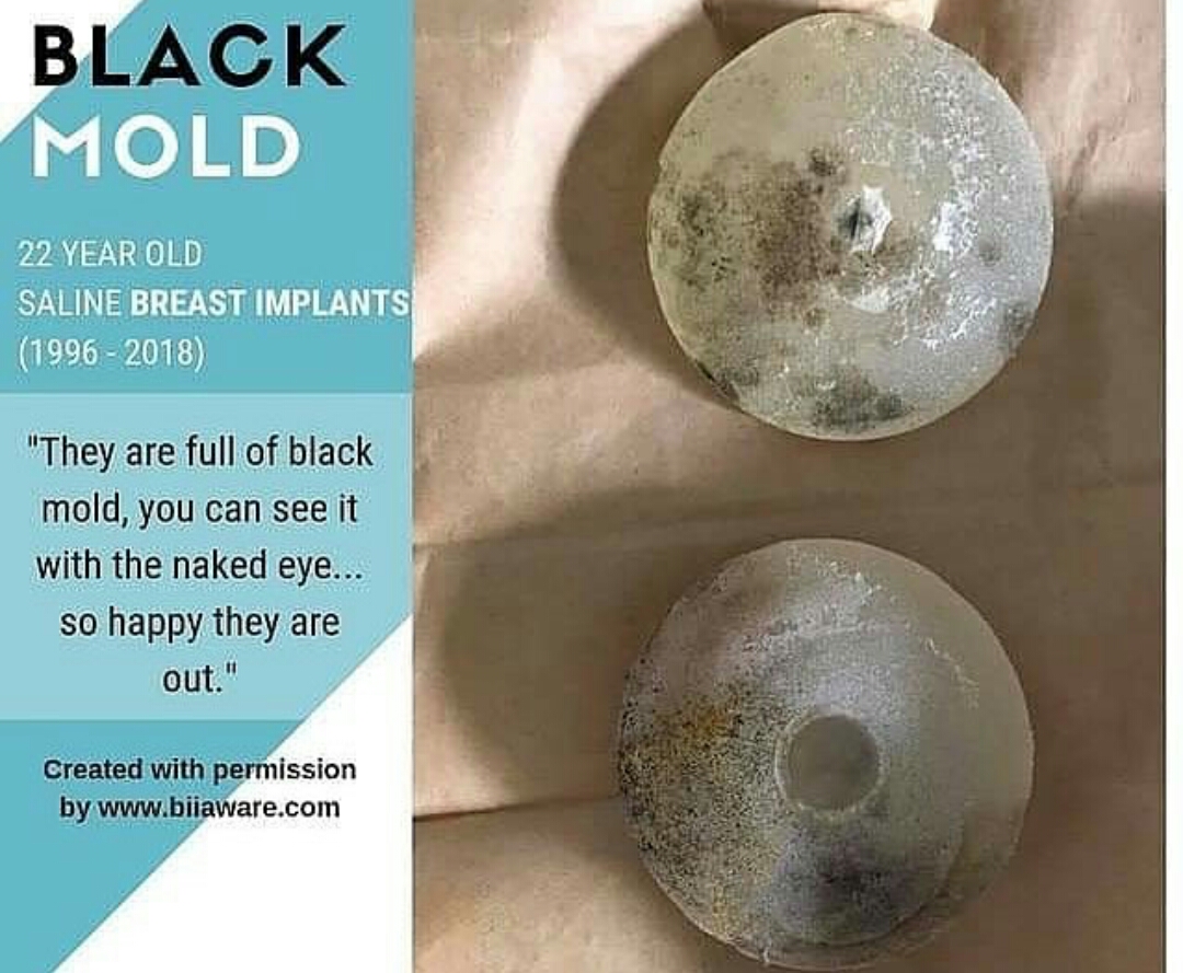 Черная плесень на грудных имплантах